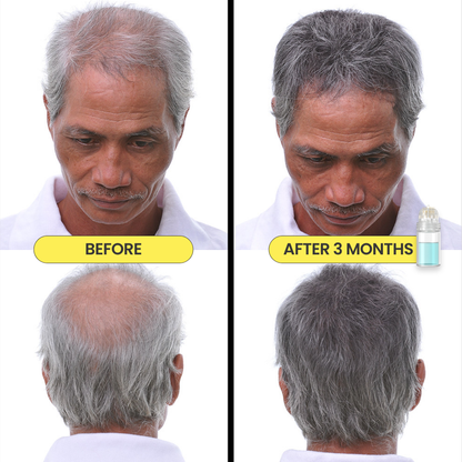 Mikro Re:Grow 30-Day Hair Regrowth System